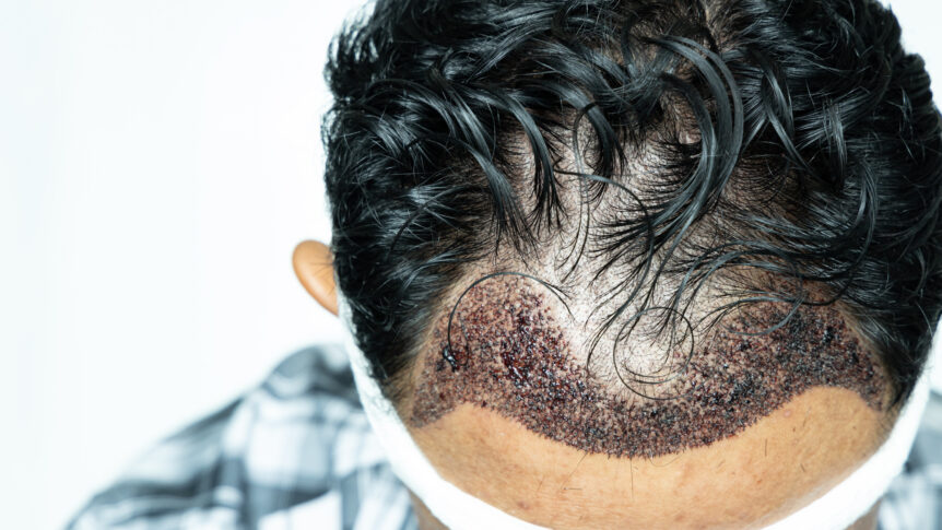 Man's head, after hair transplant surgery for receding hair line