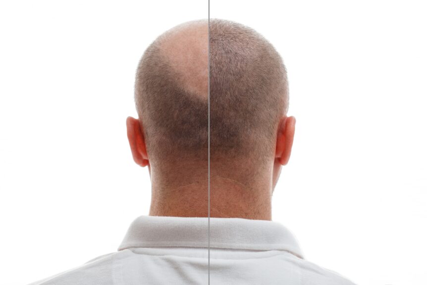 The head of a balding man before and after hair transplant surgery