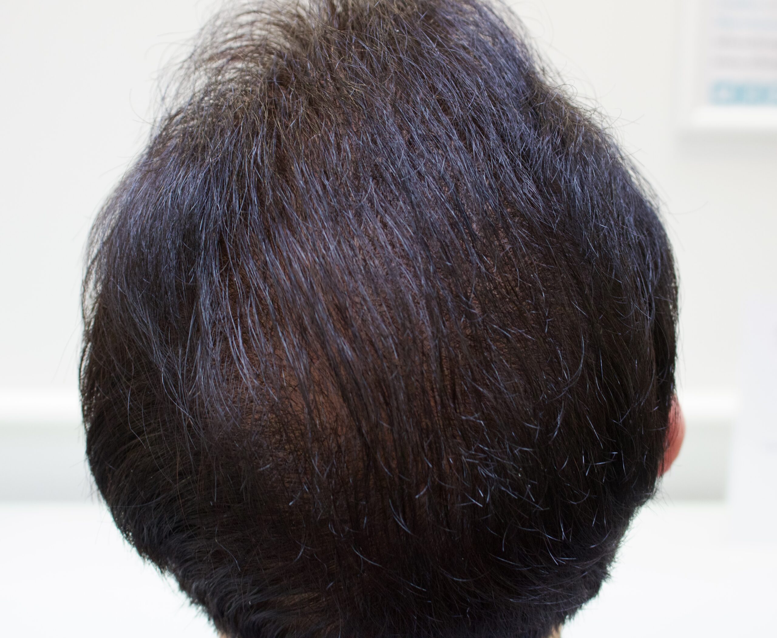 Tailored Hair Restoration for a man in His Late 30s