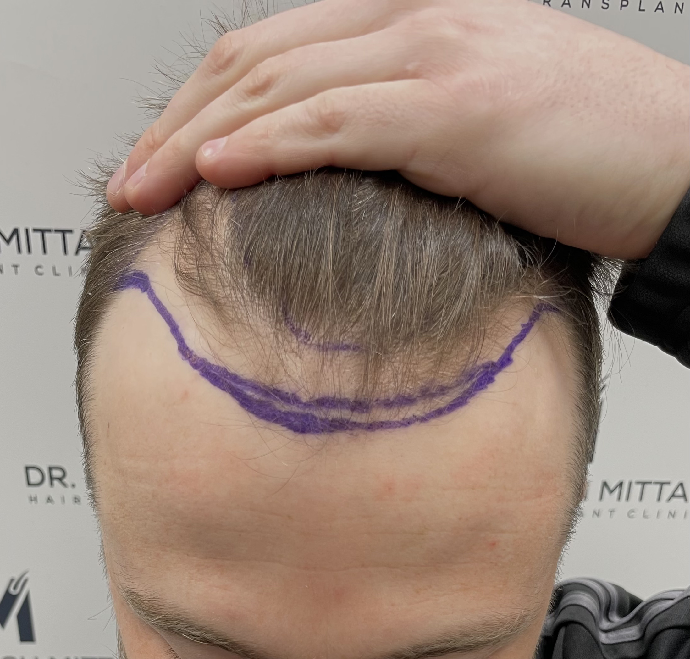 good candidate for a hair transplant