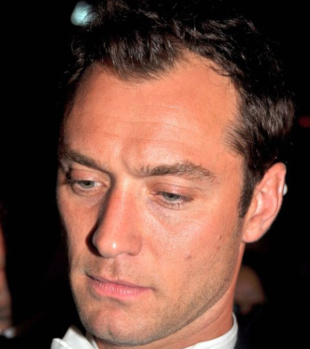 Jude Law hair transplant