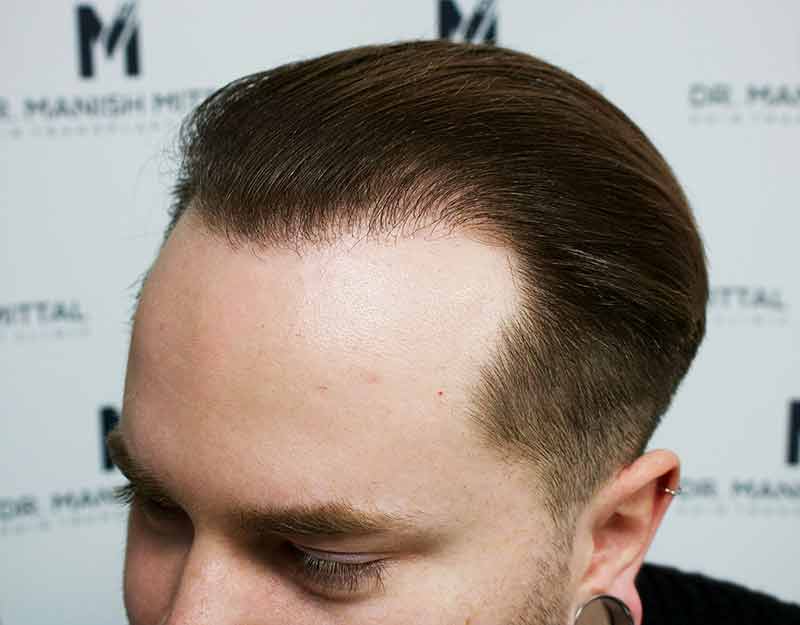 After Hair Transplant Patient 2