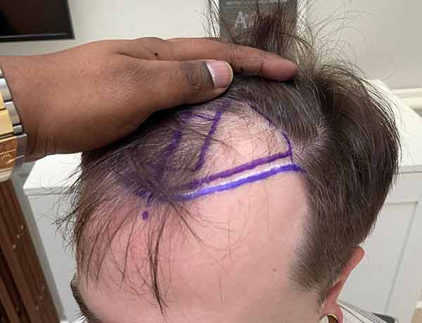 Before Hair Transplant Patient 2