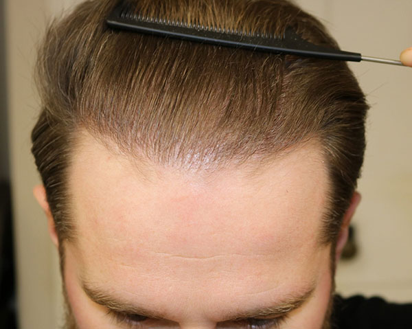 How long does a hair transplant last
