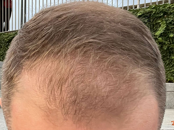 Before Hair Transplant Patient 1