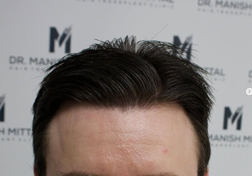 image of a hair transplant in London