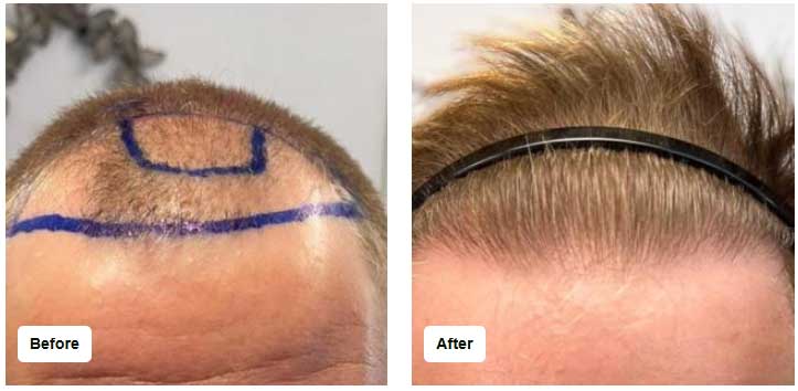 hairline transplant before and after