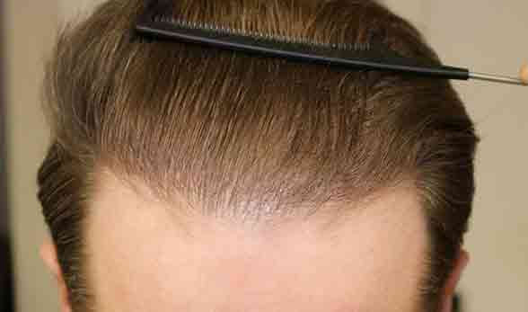 Natural close-up hairline result