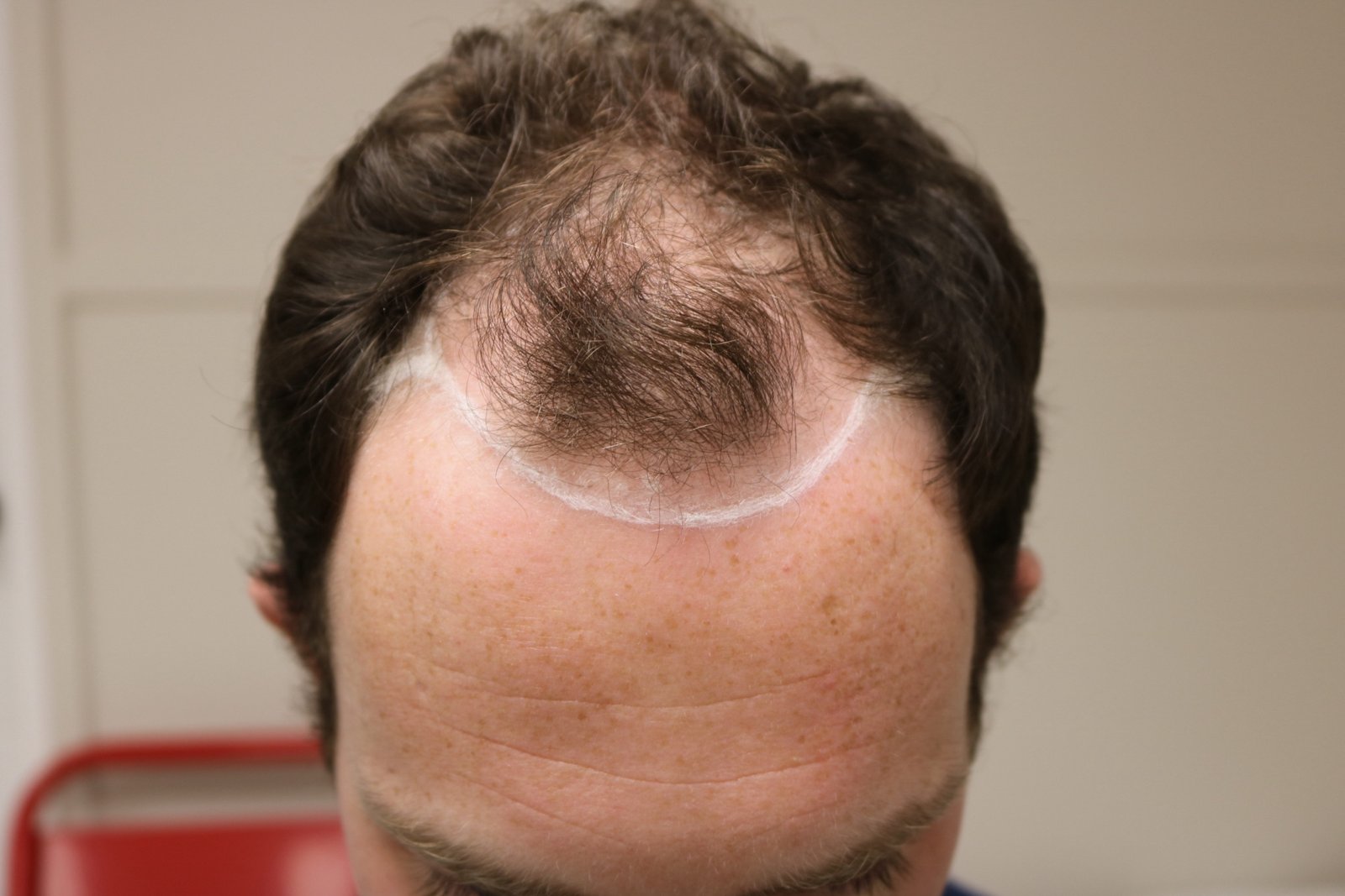 Phillip M — before