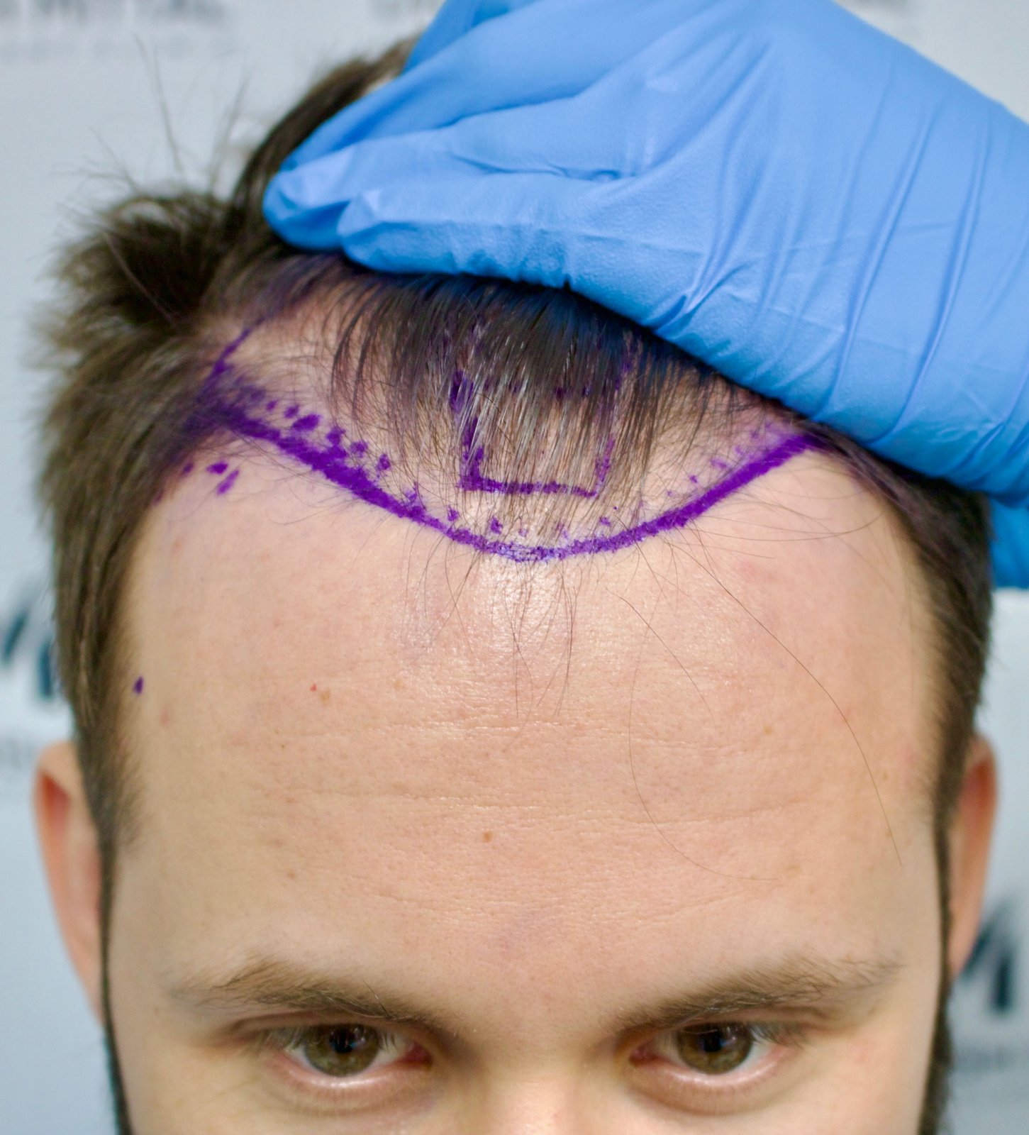 Yoni — before