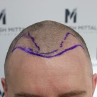 Kevin S Before