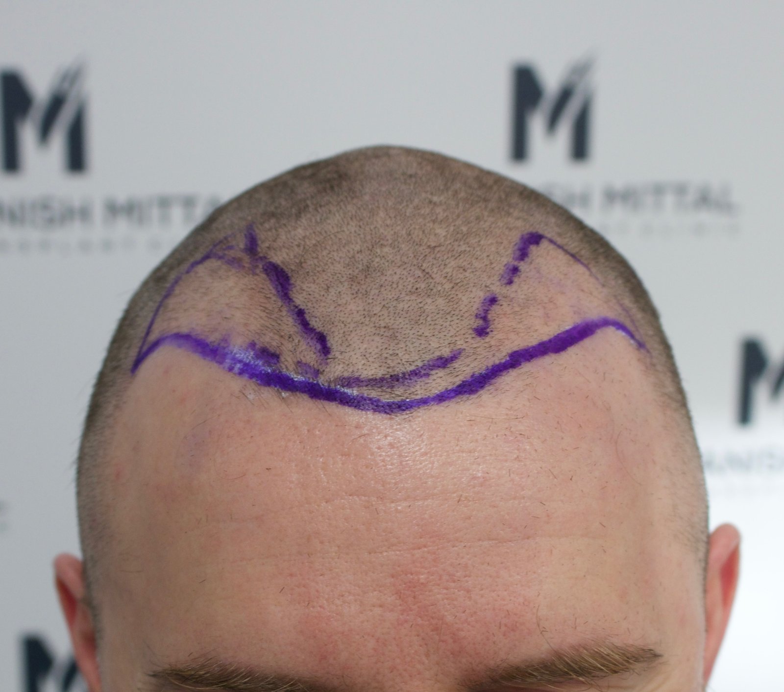 Kevin S — before