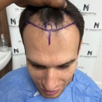 Ben Lewis Before