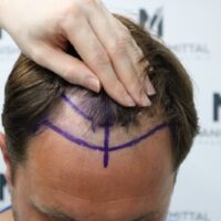 Tyler Moret Before